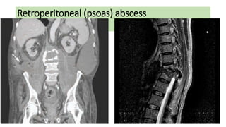 Retroperitoneal (psoas) abscess
Clinical presentation
.
 