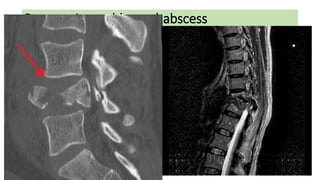 Retroperitoneal (psoas) abscess
.
 