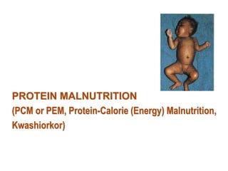 PROTEIN MALNUTRITION
(PCM or PEM, Protein-Calorie (Energy) Malnutrition,
Kwashiorkor)
 
