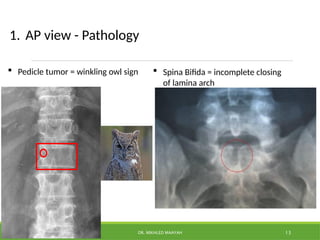 Lecture 4- imaging of the thoracic and Lumbosacral spine .pptx