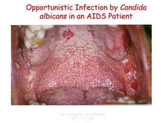 Zarqa Private UniversityBiology
4223 – The Fungi
Opportunistic Infection by Candida
albicans in an AIDS Patient
 