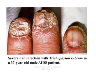 Zarqa Private UniversityBiology
4223 – The Fungi
Severe nail infection with Trichophyton rubrum in
a 37-year-old male AIDS...
