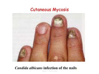 Zarqa Private UniversityBiology
4223 – The Fungi
Cutaneous Mycosis
Candida albicans infection of the nails.
 