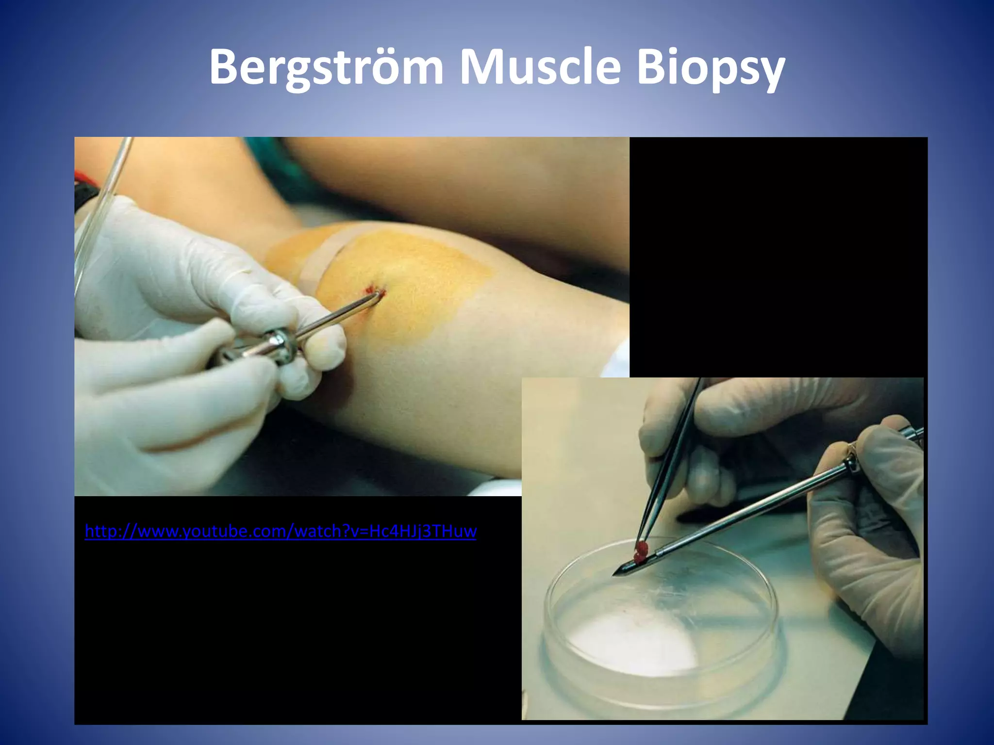 Bergström Muscle Biopsy
http://www.youtube.com/watch?v=Hc4HJj3THuw
 