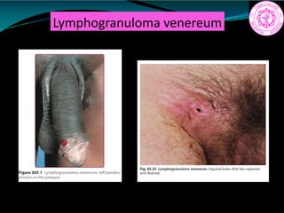 Lymphogranuloma venereum
 