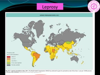 Leprosy
 