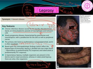Leprosy
Winalidmay
9
TE
1821isno Iwa TWio e atcans
eye
aizshrmllenee.IE
 