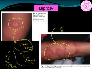 Leprosy
9
a
If
see
 