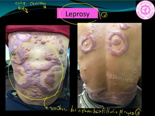 Leprosy
Cf antides
a
mentor but
nobands
infiltration
 