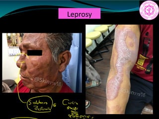 Leprosy
17
9
S1 Corti
03680
14,011s
 