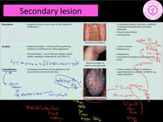 Secondary lesion
boy
C
1fiYaenemanddosanssunetroda
Going
119mash
mcreastcvshinyain.GG
satugagyg
A itcrant
Tonino
Daithlichenifiatis 00028
who
title Misor lot
 