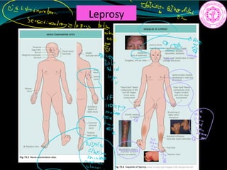 Leprosy
Éuaap man
as has
a
ae FE
Drow
Ein
C
2ⁿᵈ
if
toolepry
Jiff qq.gg
ff
 