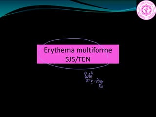Erythema multiforme
SJS/TEN
c
8810T
c
 