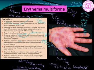 Erythema multiforme
Ematecatizuucuriioidgain.ca
what
ify
t
necting Emg
51
bvtorurticaicerecet.int
ysunood Tfecation
Yvan
wrong
www
in
n
tiiifi
ME
tupian
12tbiatiieyginnn.am
C man at
Bataanbutumanadaina talmwnwobutoroslitsns.sk
 
