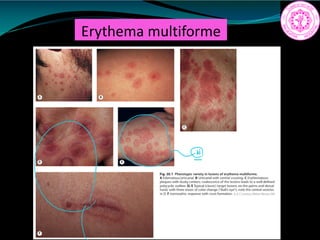 Erythema multiforme
Q
 