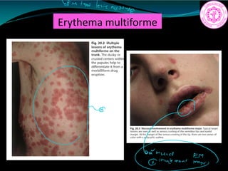 Erythema multiforme
em taget lesion
my32m
A
n mnE
 