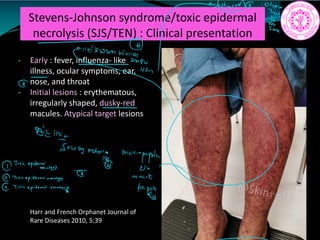 Stevens-Johnson syndrome/toxic epidermal
necrolysis (SJS/TEN) : Clinical presentation
- Early : fever, influenza- like
illness, ocular symptoms, ear,
nose, and throat
- Initial lesions : erythematous,
irregularly shaped, dusky-red
macules. Atypical target lesions
Harr and French Orphanet Journal of
Rare Diseases 2010, 5:39
Iii
right
money.name mppI
Tonicepiderminy
Cb
mail
it t.ie
 