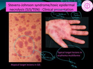Stevens-Johnson syndrome/toxic epidermal
necrolysis (SJS/TEN) : Clinical presentation
Atypical target lesions in SJS
Typical target lesions in
erythema multiforme
Trxicepidermalnav.lyg
TriaieGEEIa. h
a
ne
Elow
 
