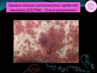 Stevens-Johnson syndrome/toxic epidermal
necrolysis (SJS/TEN) : Clinical presentation
dya fifteen
 