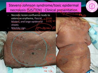 Stevens-Johnson syndrome/toxic epidermal
necrolysis (SJS/TEN) : Clinical presentation
- Necrotic lesion confluence leads to
extensive erythema, flaccid
blisters, and large epidermal
sheets
- Nikolsky sign
m
brinating
into
 