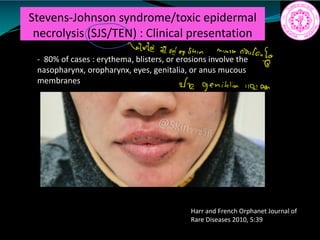 Stevens-Johnson syndrome/toxic epidermal
necrolysis (SJS/TEN) : Clinical presentation
- 80% of cases : erythema, blisters, or erosions involve the
nasopharynx, oropharynx, eyes, genitalia, or anus mucous
membranes
Harr and French Orphanet Journal of
Rare Diseases 2010, 5:39
1
Gate and a shin mussa
rindouf
In genitalia 1101non
 