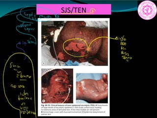 SJS/TEN
1f
a
gin E
in
 