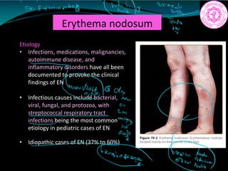 Erythema nodosum
Etiology
• Infections, medications, malignancies,
autoimmune disease, and
inflammatory disorders have all been
documented to provoke the clinical
findings of EN
• Infectious causes include bacterial,
viral, fungal, and protozoa, with
streptococcal respiratory tract
infections being the most common
etiology in pediatric cases of EN
• Idiopathic cases of EN (37% to 60%)
1 7 91
EN Eutheranoulestly
g 2kg
Te
draw
Eis
T.name ii.t
 