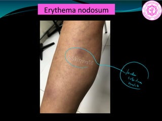 Erythema nodosum
R
 