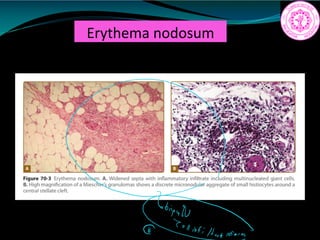 Erythema nodosum
i nn
 