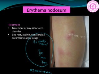 Erythema nodosum
Treatment
• Treatment of any associated
disorder
• Bed rest, aspirin, nonsteroidal
antiinflammatory drugs
mniÉ
iii
DI Mannv15
 