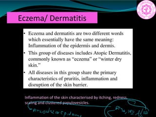 Eczema/ Dermatitis
Inflammation of the skin characterised by itching, redness,
scaling and clustered papulovesicles.
 