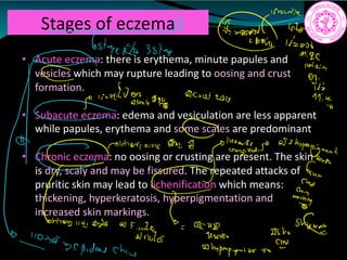 Stages of eczema
• Acute eczema: there is erythema, minute papules and
vesicles which may rupture leading to oosing and crust
formation.
• Subacute eczema: edema and vesiculation are less apparent
while papules, erythema and some scales are predominant
• Chronic eczema: no oosing or crusting are present. The skin
is dry, scaly and may be fissured. The repeated attacks of
pruritic skin may lead to lichenification which means:
thickening, hyperkeratosis, hyperpigmentation and
increased skin markings.
Into
iii
6st
sept 3sta
if
piiind089 ua cuetwb 17 c
stinarians 84 21 152 p athperpigment
ar
Enn
Cha
F
ftp.fifg
042m 052
84msec
Whperpigmatan a
crest
 