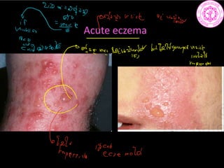 Acute eczema
aug
7 again
0122very dokubniygddlutfaugrapefves.de
loutails
terpressler
9
Lalu
detecting Else mold
 