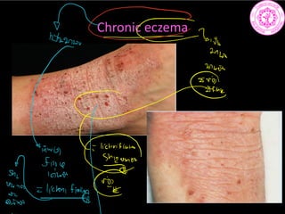 Chronic eczema
In
2166
3745h
ma
Gi
yifiii.ae
ñw
 