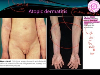 Atopic dermatitis
s
none
aor
6
1
b
awley
110
 