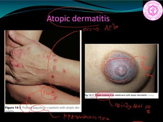 Atopic dermatitis
or
PMG
GivingAdut
AI
paperanounit 1cm
 