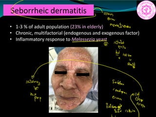 Seborrheic dermatitis
• 1-3 % of adult population (23% in elderly)
• Chronic, multifactorial (endogenous and exogenous factor)
• Inflammatory response to Malassezia yeast
Ñ
2iwv
1
1
gang
10T
Solders
prep essen
iiii.IE
 