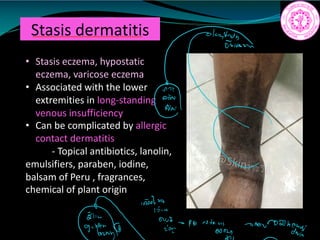 Stasis dermatitis
• Stasis eczema, hypostatic
eczema, varicose eczema
• Associated with the lower
extremities in long-standing
venous insufficiency
• Can be complicated by allergic
contact dermatitis
- Topical antibiotics, lanolin,
emulsifiers, paraben, iodine,
balsam of Peru , fragrances,
chemical of plant origin
an
retiring among
 