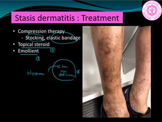 Stasis dermatitis : Treatment
• Compression therapy
- Stocking, elastic bandage
• Topical steroid
• Emollient
co
staeon
 