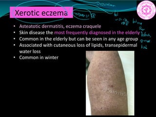 Xerotic eczema
• Asteatotic dermatitis, eczema craquele
• Skin disease the most frequently diagnosed in the elderly
• Common in the elderly but can be seen in any age group
• Associated with cutaneous loss of lipids, transepidermal
water loss
• Common in winter
in
inside btrare
2
Wow
0771N
bob
 