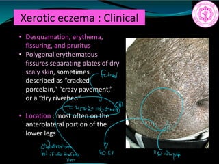 Xerotic eczema : Clinical
• Desquamation, erythema,
fissuring, and pruritus
• Polygonal erythematous
fissures separating plates of dry
scaly skin, sometimes
described as “cracked
porcelain,” “crazy pavement,”
or a “dry riverbed”
• Location : most often on the
anterolateral portion of the
lower legs
fation
f1t .tk
i i adult
 