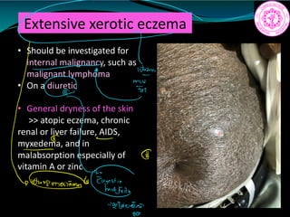 Extensive xerotic eczema
• Should be investigated for
internal malignancy, such as
malignant lymphoma
• On a diuretic
• General dryness of the skin
>> atopic eczema, chronic
renal or liver failure, AIDS,
myxedema, and in
malabsorption especially of
vitamin A or zinc
C
pantsuit
11
295
0552
 