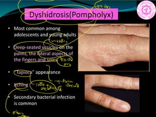 Dyshidrosis(Pompholyx)
• Most common among
adolescents and young adults
• Deep-seated vesicles on the
palms, the lateral aspects of
the fingers and soles
• “Tapioca” appearance
• Itching
• Secondary bacterial infection
is common
0tG
91 no
85502
 