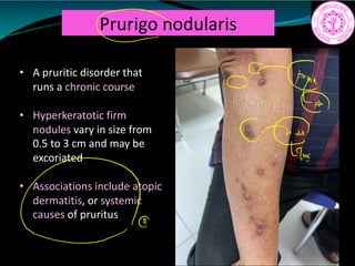 Prurigo nodularis
• A pruritic disorder that
runs a chronic course
• Hyperkeratotic firm
nodules vary in size from
0.5 to 3 cm and may be
excoriated
• Associations include atopic
dermatitis, or systemic
causes of pruritus
c
ftp.G
C
Lan
 