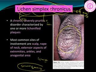 Lichen simplex chronicus
• A chronic, severely pruritic
disorder characterized by
one or more lichenified
plaques
• Most common sites of
involvement are scalp, nape
of neck, extensor aspects of
extremities, ankles, and
anogenital area
lictimist
Shinchstemoning
 