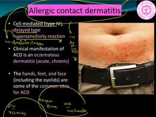 Allergic contact dermatitis
• Cell-mediated (type IV),
delayed type
hypersensitivity reaction
• Clinical manifestation of
ACD is an eczematous
dermatitis (acute, chronic)
• The hands, feet, and face
(including the eyelids) are
some of the common sites
for ACD
M 11W
inardaladalaithner
y
i
ñ
Fiurio
 