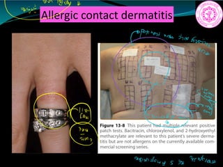Allergic contact dermatitis
avw.mh
t peJtnninsurin ir
aic
C.e.am
iifi
2022604 s
3ndaug
 