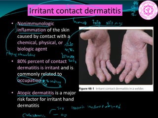 Irritant contact dermatitis
• Nonimmunologic
inflammation of the skin
caused by contact with a
chemical, physical, or
biologic agent
• 80% percent of contact
dermatitis is irritant and is
commonly related to
occupation
• Atopic dermatitis is a major
risk factor for irritant hand
dermatitis
N
Yift
1 Who
470
ptysigatomialla.us
8211429
p
GerminG
looioni twifordtwfai.sn
Cotcldematii I
 