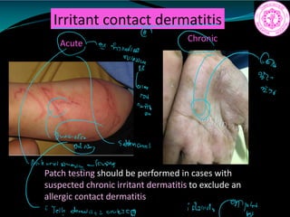 Irritant contact dermatitis
Acute
Patch testing should be performed in cases with
suspected chronic irritant dermatitis to exclude an
allergic contact dermatitis
Chronic
a
feminine
ms
Vinny 002
6110
row
i
suddennial
Elina
oppitch
 