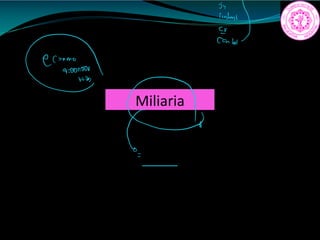 Miliaria
a
s
outed
e
o
 